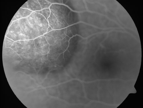 Choroidal Metastases - Both Eyes - Exudative Retinal Detachment
58-year-old man smoke a pack of cigarettes a day.  He has had some ribcage pain for about the last two weeks.  He also had a sinus infection for about two weeks, and he has also had hazy vision on the superior visual field in the left eye for about the last two weeks. vision is 20/25 in both eyes
