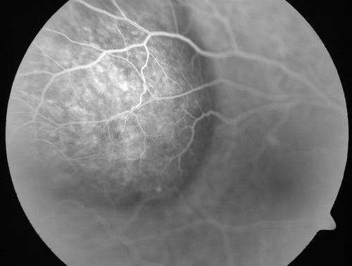 Choroidal Metastases - Both Eyes - Exudative Retinal Detachment
58-year-old man smoke a pack of cigarettes a day.  He has had some ribcage pain for about the last two weeks.  He also had a sinus infection for about two weeks, and he has also had hazy vision on the superior visual field in the left eye for about the last two weeks. vision is 20/25 in both eyes
