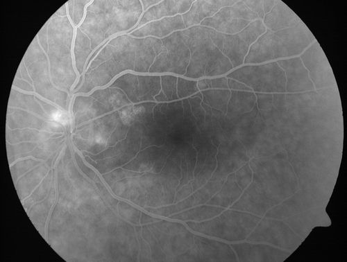 Choroidal Metastases - Both Eyes - Exudative Retinal Detachment
58-year-old man smoke a pack of cigarettes a day.  He has had some ribcage pain for about the last two weeks.  He also had a sinus infection for about two weeks, and he has also had hazy vision on the superior visual field in the left eye for about the last two weeks. vision is 20/25 in both eyes
