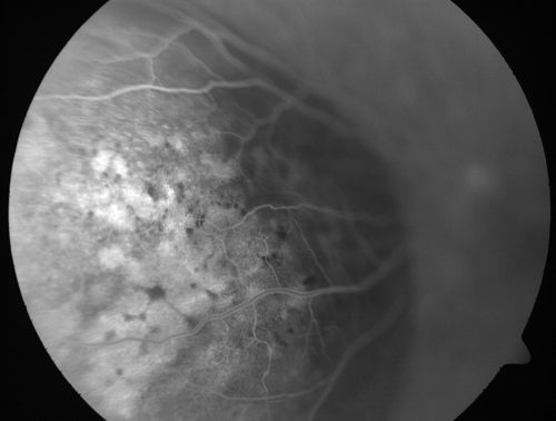 Choroidal Metastases - Both Eyes - Exudative Retinal Detachment
58-year-old man smoke a pack of cigarettes a day.  He has had some ribcage pain for about the last two weeks.  He also had a sinus infection for about two weeks, and he has also had hazy vision on the superior visual field in the left eye for about the last two weeks. vision is 20/25 in both eyes
