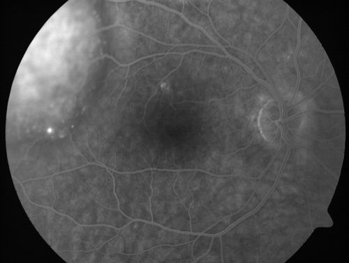 Choroidal Metastases - Both Eyes - Exudative Retinal Detachment
58-year-old man smoke a pack of cigarettes a day.  He has had some ribcage pain for about the last two weeks.  He also had a sinus infection for about two weeks, and he has also had hazy vision on the superior visual field in the left eye for about the last two weeks. vision is 20/25 in both eyes
