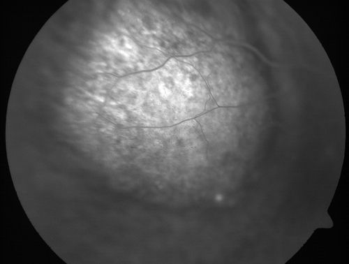 Choroidal Metastases - Both Eyes - Exudative Retinal Detachment
58-year-old man smoke a pack of cigarettes a day.  He has had some ribcage pain for about the last two weeks.  He also had a sinus infection for about two weeks, and he has also had hazy vision on the superior visual field in the left eye for about the last two weeks. vision is 20/25 in both eyes

