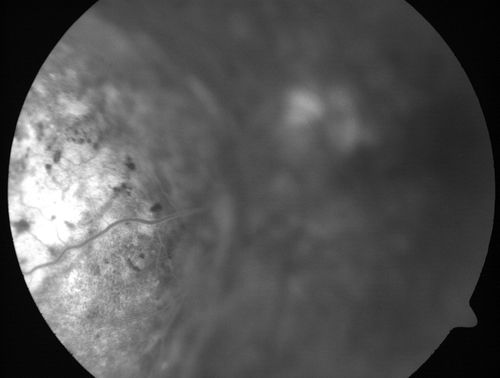 Choroidal Metastases - Both Eyes - Exudative Retinal Detachment
58-year-old man smoke a pack of cigarettes a day.  He has had some ribcage pain for about the last two weeks.  He also had a sinus infection for about two weeks, and he has also had hazy vision on the superior visual field in the left eye for about the last two weeks. vision is 20/25 in both eyes
