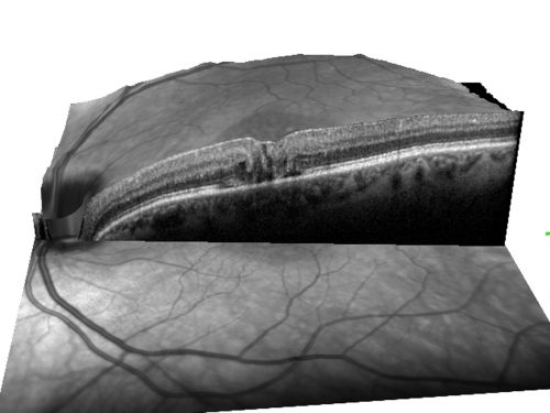 Juxtafoveal Telangiectasis - Stage 5 Left Eye - New Blood and Neovascularization MacTel 
60-year-old man has juxtafoveal retinal telangiectasis recent vision loss OD 20/50,  OS 20/70 : Hemorrhage OS and new SRNVM

