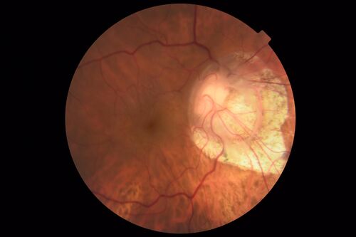 Tilted Disc Syndrome
56 year old female.  Recent motor vehicle accident.  Vision is 20/50 OD, 20/25 OS.
