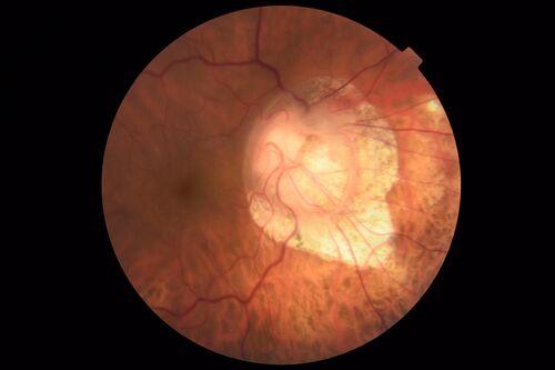 Tilted Disc Syndrome
56 year old female.  Recent motor vehicle accident.  Vision is 20/50 OD, 20/25 OS.
