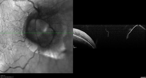 Tilted Disc Syndrome
56 year old female.  Recent motor vehicle accident.  Vision is 20/50 OD, 20/25 OS.
