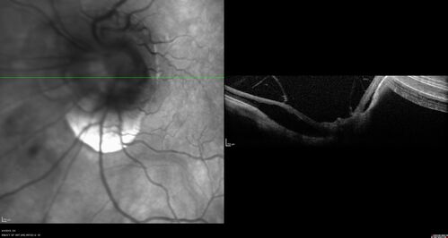 Tilted Disc Syndrome
56 year old female.  Recent motor vehicle accident.  Vision is 20/50 OD, 20/25 OS.
