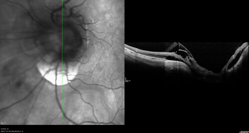 Tilted Disc Syndrome
56 year old female.  Recent motor vehicle accident.  Vision is 20/50 OD, 20/25 OS.
