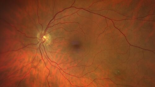 Torpedo Maculopathy - Small Lesion
Asymptomatic 77 year old female
