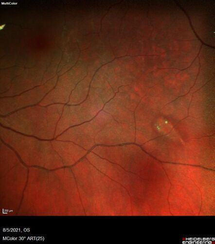 Torpedo Maculopathy - Small Lesion
Asymptomatic 77 year old female
