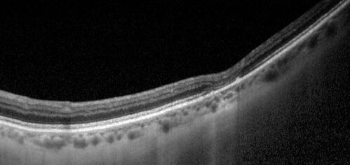 Torpedo Maculopathy - Small Lesion
Asymptomatic 77 year old female
