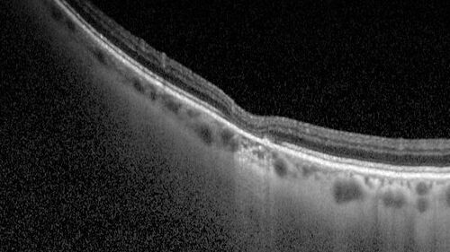 Torpedo Maculopathy - Small Lesion
Asymptomatic 77 year old female
