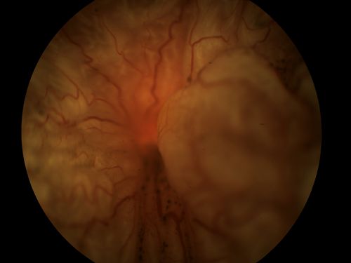 Total Retinal Detachment
Total Retinal Detachment
