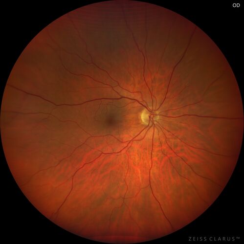 Recurrent toxoplasmosis
63 year old female with history of floaters and vision loss in the left eye.

