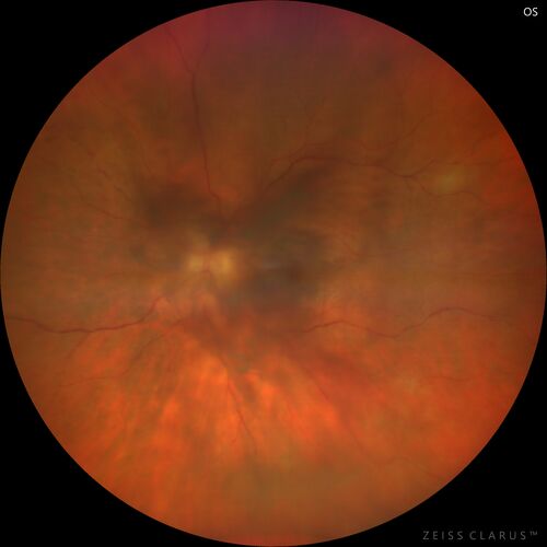 Recurrent toxoplasmosis
63 year old female with history of floaters and vision loss in the left eye.
