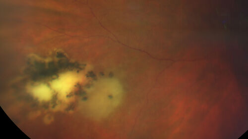 Recurrent toxoplasmosis
63 year old female with history of floaters and vision loss in the left eye.
