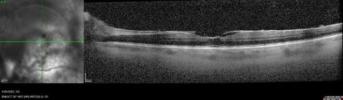 Recurrent toxoplasmosis
63 year old female with history of floaters and vision loss in the left eye.
