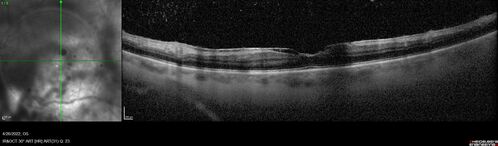 Recurrent toxoplasmosis
63 year old female with history of floaters and vision loss in the left eye.
