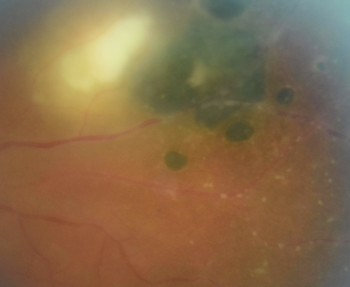 Toxoplasmosis - Recurrent - Moderate Vitritis
32 year old woman with 20/80 vision and moderately painful red eye in the left eye only.  The left eye had some redness about 10 years ago.  She is a native of Sierra Leone
