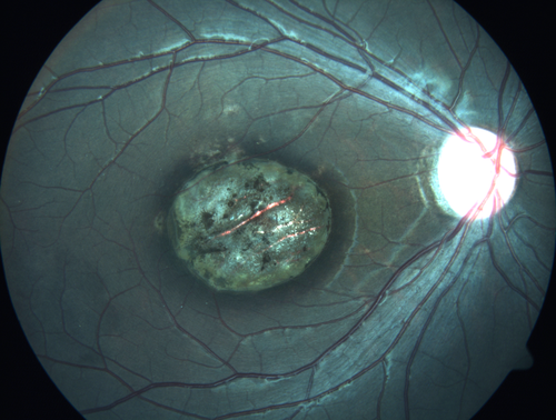 Congenital Toxoplasmosis Right Eye - Macular Scar
6 year old child who immigrated from Brazil and failed school screening .  VA OD 20/200
