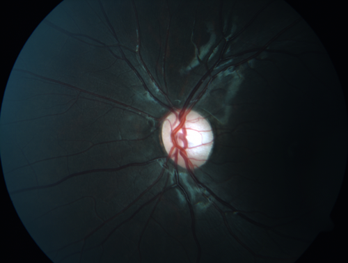 Congenital Toxoplasmosis Right Eye - Macular Scar
6 year old child who immigrated from Brazil and failed school screening .  VA OD 20/200
