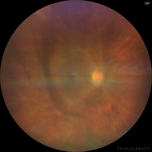 Toxoplasmosis right eye with diffuse retinal vascular whitening PCR confirmed
66 year old man The patient was doing fine until about 2-3 months ago.Â  He woke up with shadows and spots in the right eye.Â  Every blue moon he gets some pain in the right eye.Â  He has been getting treated with eye drops in the right eye.Â  Since this happened the vision is mostly the same.Â  Sometimes he sees better than other times.Â  He has not been treated with oral medications.Â Â 
Medical history: none â€“ Medications: none, ROS negative
VA OD: sc20/63-1 OS: sc20/20 
IOP: TP: OD:15 OS:20Â 
Negative labs: ACE, Lysozyme, RPR, HLA B27, Quant TB Gold, ESR (slight elevation of CRP)
PCR anterior chamber: negative herpes virus (HSV, VZV, CMV)
Positive for toxoplasmosis
