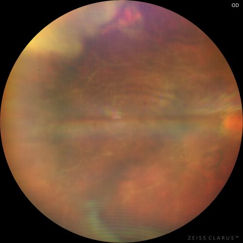 Toxoplasmosis right eye with diffuse retinal vascular whitening PCR confirmed
66 year old man The patient was doing fine until about 2-3 months ago.Â  He woke up with shadows and spots in the right eye.Â  Every blue moon he gets some pain in the right eye.Â  He has been getting treated with eye drops in the right eye.Â  Since this happened the vision is mostly the same.Â  Sometimes he sees better than other times.Â  He has not been treated with oral medications.Â Â 
Medical history: none â€“ Medications: none, ROS negative
VA OD: sc20/63-1 OS: sc20/20 
IOP: TP: OD:15 OS:20Â 
Negative labs: ACE, Lysozyme, RPR, HLA B27, Quant TB Gold, ESR (slight elevation of CRP)
PCR anterior chamber: negative herpes virus (HSV, VZV, CMV)
Positive for toxoplasmosis
