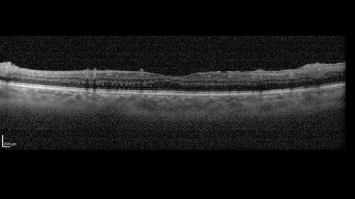 Toxoplasmosis right eye with diffuse retinal vascular whitening PCR confirmed
66 year old man The patient was doing fine until about 2-3 months ago.Â  He woke up with shadows and spots in the right eye.Â  Every blue moon he gets some pain in the right eye.Â  He has been getting treated with eye drops in the right eye.Â  Since this happened the vision is mostly the same.Â  Sometimes he sees better than other times.Â  He has not been treated with oral medications.Â Â 
Medical history: none â€“ Medications: none, ROS negative
VA OD: sc20/63-1 OS: sc20/20 
IOP: TP: OD:15 OS:20Â 
Negative labs: ACE, Lysozyme, RPR, HLA B27, Quant TB Gold, ESR (slight elevation of CRP)
PCR anterior chamber: negative herpes virus (HSV, VZV, CMV)
Positive for toxoplasmosis
