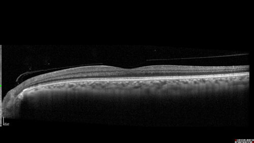 Toxoplasmosis right eye with diffuse retinal vascular whitening PCR confirmed
66 year old man The patient was doing fine until about 2-3 months ago.Â  He woke up with shadows and spots in the right eye.Â  Every blue moon he gets some pain in the right eye.Â  He has been getting treated with eye drops in the right eye.Â  Since this happened the vision is mostly the same.Â  Sometimes he sees better than other times.Â  He has not been treated with oral medications.Â Â 
Medical history: none â€“ Medications: none, ROS negative
VA OD: sc20/63-1 OS: sc20/20 
IOP: TP: OD:15 OS:20Â 
Negative labs: ACE, Lysozyme, RPR, HLA B27, Quant TB Gold, ESR (slight elevation of CRP)
PCR anterior chamber: negative herpes virus (HSV, VZV, CMV)
Positive for toxoplasmosis
