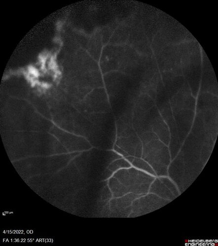 Toxoplasmosis right eye with diffuse retinal vascular whitening PCR confirmed
66 year old man The patient was doing fine until about 2-3 months ago.Â  He woke up with shadows and spots in the right eye.Â  Every blue moon he gets some pain in the right eye.Â  He has been getting treated with eye drops in the right eye.Â  Since this happened the vision is mostly the same.Â  Sometimes he sees better than other times.Â  He has not been treated with oral medications.Â Â 
Medical history: none â€“ Medications: none, ROS negative
VA OD: sc20/63-1 OS: sc20/20 
IOP: TP: OD:15 OS:20Â 
Negative labs: ACE, Lysozyme, RPR, HLA B27, Quant TB Gold, ESR (slight elevation of CRP)
PCR anterior chamber: negative herpes virus (HSV, VZV, CMV)
Positive for toxoplasmosis
