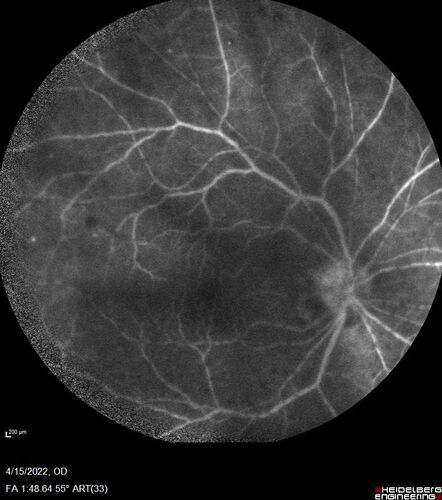 Toxoplasmosis right eye with diffuse retinal vascular whitening PCR confirmed
66 year old man The patient was doing fine until about 2-3 months ago.Â  He woke up with shadows and spots in the right eye.Â  Every blue moon he gets some pain in the right eye.Â  He has been getting treated with eye drops in the right eye.Â  Since this happened the vision is mostly the same.Â  Sometimes he sees better than other times.Â  He has not been treated with oral medications.Â Â 
Medical history: none â€“ Medications: none, ROS negative
VA OD: sc20/63-1 OS: sc20/20 
IOP: TP: OD:15 OS:20Â 
Negative labs: ACE, Lysozyme, RPR, HLA B27, Quant TB Gold, ESR (slight elevation of CRP)
PCR anterior chamber: negative herpes virus (HSV, VZV, CMV)
Positive for toxoplasmosis
