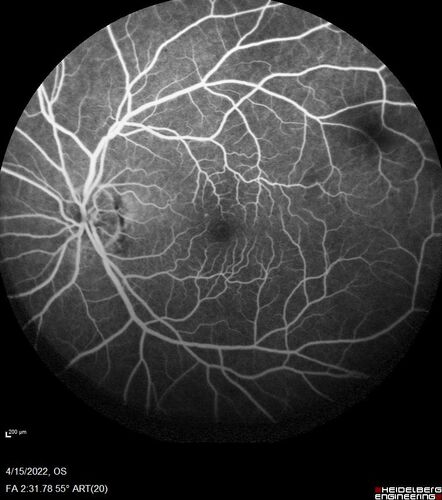 Toxoplasmosis right eye with diffuse retinal vascular whitening PCR confirmed
66 year old man The patient was doing fine until about 2-3 months ago.Â  He woke up with shadows and spots in the right eye.Â  Every blue moon he gets some pain in the right eye.Â  He has been getting treated with eye drops in the right eye.Â  Since this happened the vision is mostly the same.Â  Sometimes he sees better than other times.Â  He has not been treated with oral medications.Â Â 
Medical history: none â€“ Medications: none, ROS negative
VA OD: sc20/63-1 OS: sc20/20 
IOP: TP: OD:15 OS:20Â 
Negative labs: ACE, Lysozyme, RPR, HLA B27, Quant TB Gold, ESR (slight elevation of CRP)
PCR anterior chamber: negative herpes virus (HSV, VZV, CMV)
Positive for toxoplasmosis
