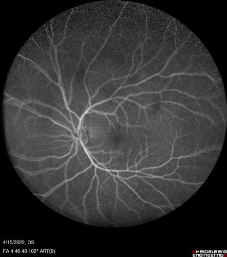Toxoplasmosis right eye with diffuse retinal vascular whitening PCR confirmed
66 year old man The patient was doing fine until about 2-3 months ago.Â  He woke up with shadows and spots in the right eye.Â  Every blue moon he gets some pain in the right eye.Â  He has been getting treated with eye drops in the right eye.Â  Since this happened the vision is mostly the same.Â  Sometimes he sees better than other times.Â  He has not been treated with oral medications.Â Â 
Medical history: none â€“ Medications: none, ROS negative
VA OD: sc20/63-1 OS: sc20/20 
IOP: TP: OD:15 OS:20Â 
Negative labs: ACE, Lysozyme, RPR, HLA B27, Quant TB Gold, ESR (slight elevation of CRP)
PCR anterior chamber: negative herpes virus (HSV, VZV, CMV)
Positive for toxoplasmosis
