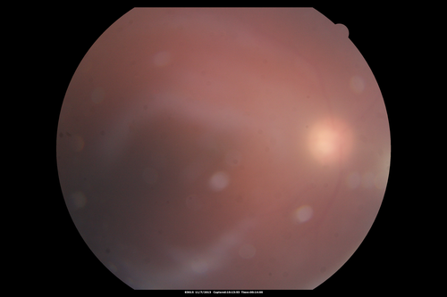 Toxoplasmosis Retinitis - Vitritis and Anerior Uveitis
