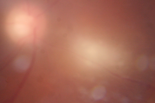 Toxoplasmosis Retinitis - Vitritis and Anerior Uveitis
