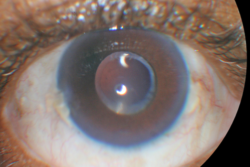 Toxoplasmosis Retinitis - Vitritis and Anerior Uveitis
Anterior Uveitis
