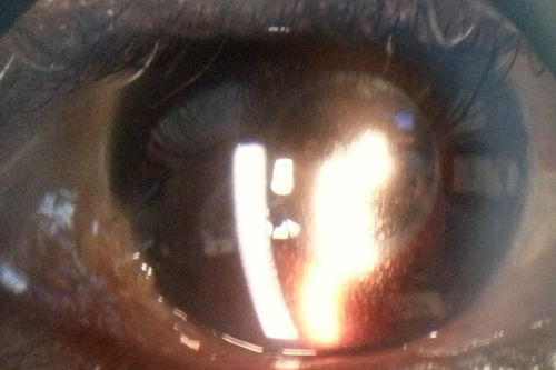 Toxoplasmosis Retinitis - Vitritis and Anerior Uveitis
Anterior Uveitis
