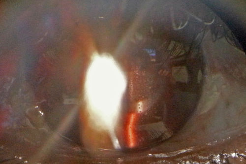 Toxoplasmosis Retinitis - Vitritis and Anerior Uveitis
Anterior Uveitis
