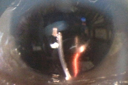 Toxoplasmosis Retinitis - Vitritis and Anerior Uveitis
Anterior Uveitis
