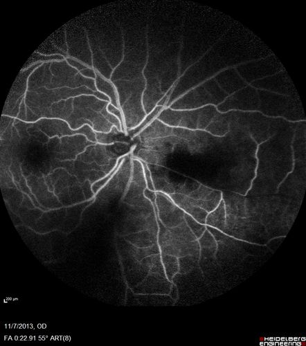 Toxoplasmosis Retinitis - Vitritis and Anerior Uveitis
