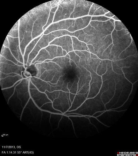 Toxoplasmosis Retinitis - Vitritis and Anerior Uveitis
