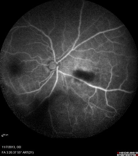 Toxoplasmosis Retinitis - Vitritis and Anerior Uveitis
