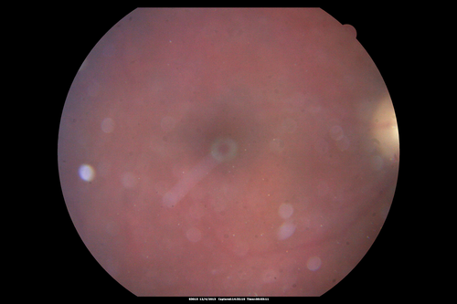 Toxoplasmosis Retinitis - Vitritis and Anerior Uveitis
2 weeks after starting treatment - lesion is involuting
