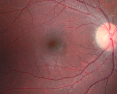 Toxoplasmosis - Reactivation 19 year old Brazilian Native
20/20 vision with recurrent floaters.  No treatment was offered because of peripheral location of the active lesion.
