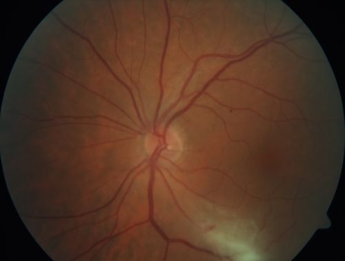 Acquired Toxoplasmosis Retinitis Para Foveal - Following Venison Consumption
56 year old man who became very sick after eating venison at the end of December 2019.  Presented 6 weeks later with a scotoma.  Initial photos show presentation with 20/63 vision.  Vision dropped to 5/200.  All tests (including PCR of anterior chamber tap) were negative except serum toxoplasmosis IgG and IgM.  Vision improved to 20/32 but the scotoma remained on oral trimetheprim/sulfa
