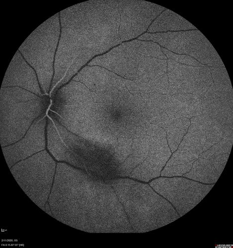 Acquired Toxoplasmosis Retinitis Para Foveal - Following Venison Consumption
56 year old man who became very sick after eating venison at the end of December 2019.  Presented 6 weeks later with a scotoma.  Initial photos show presentation with 20/63 vision.  Vision dropped to 5/200.  All tests (including PCR of anterior chamber tap) were negative except serum toxoplasmosis IgG and IgM.  Vision improved to 20/32 but the scotoma remained on oral trimetheprim/sulfa
