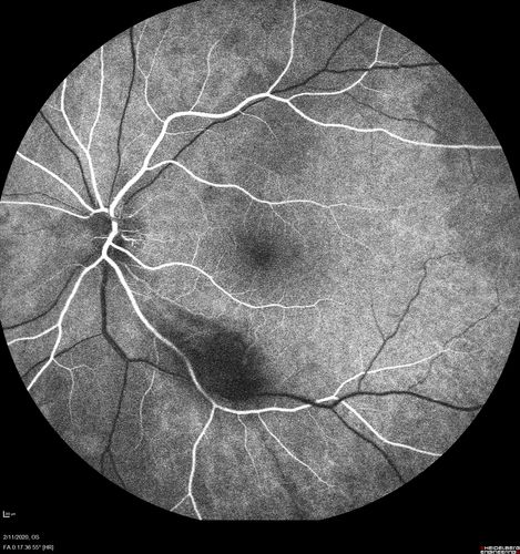 Acquired Toxoplasmosis Retinitis Para Foveal - Following Venison Consumption
56 year old man who became very sick after eating venison at the end of December 2019.  Presented 6 weeks later with a scotoma.  Initial photos show presentation with 20/63 vision.  Vision dropped to 5/200.  All tests (including PCR of anterior chamber tap) were negative except serum toxoplasmosis IgG and IgM.  Vision improved to 20/32 but the scotoma remained on oral trimetheprim/sulfa
