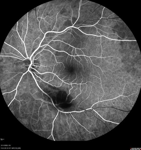 Acquired Toxoplasmosis Retinitis Para Foveal - Following Venison Consumption
56 year old man who became very sick after eating venison at the end of December 2019.  Presented 6 weeks later with a scotoma.  Initial photos show presentation with 20/63 vision.  Vision dropped to 5/200.  All tests (including PCR of anterior chamber tap) were negative except serum toxoplasmosis IgG and IgM.  Vision improved to 20/32 but the scotoma remained on oral trimetheprim/sulfa
