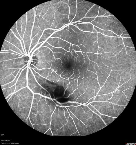 Acquired Toxoplasmosis Retinitis Para Foveal - Following Venison Consumption
56 year old man who became very sick after eating venison at the end of December 2019.  Presented 6 weeks later with a scotoma.  Initial photos show presentation with 20/63 vision.  Vision dropped to 5/200.  All tests (including PCR of anterior chamber tap) were negative except serum toxoplasmosis IgG and IgM.  Vision improved to 20/32 but the scotoma remained on oral trimetheprim/sulfa
